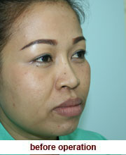 plastic_surgery_augmentation_rhinoplasty